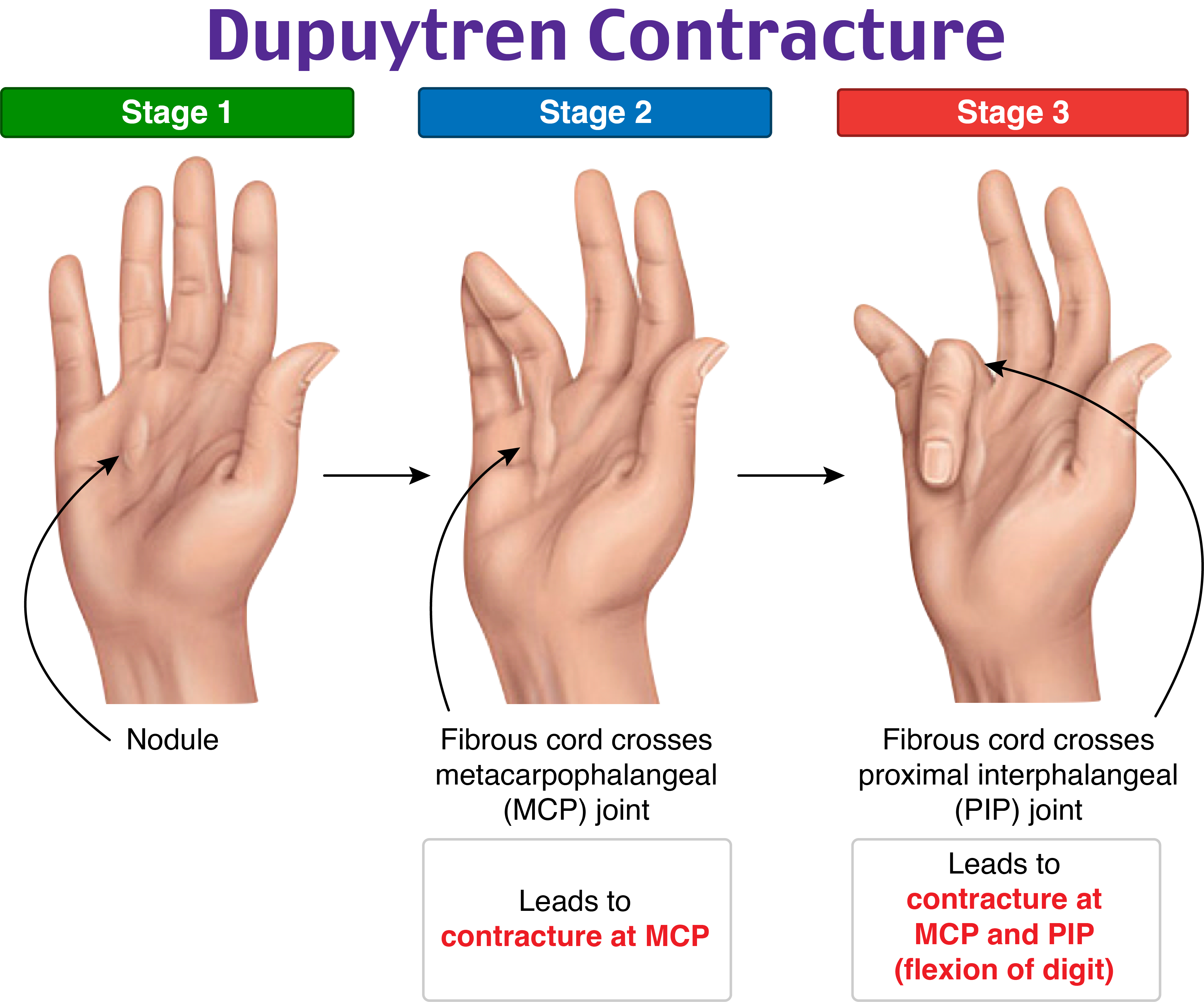 EmDOCs.net – Emergency Medicine EducationEM@3AM: Extensor Tendon ...